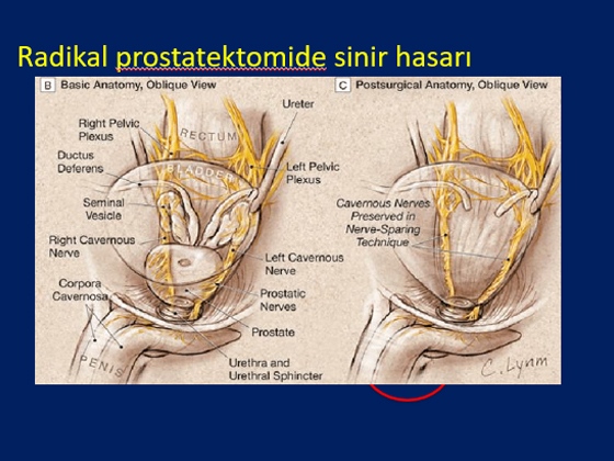 Radikal Prostatektomi Sonrası Erektil Disfonksiyon