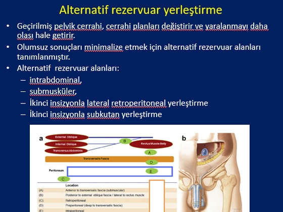 Radikal Prostatektomi Sonrası Erektil Disfonksiyon