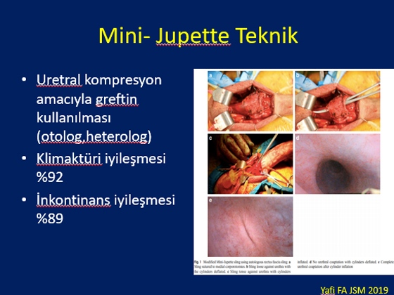 Radikal Prostatektomi Sonrası Erektil Disfonksiyon