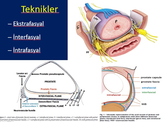 Radikal Prostatektomi Sonrası Erektil Disfonksiyon