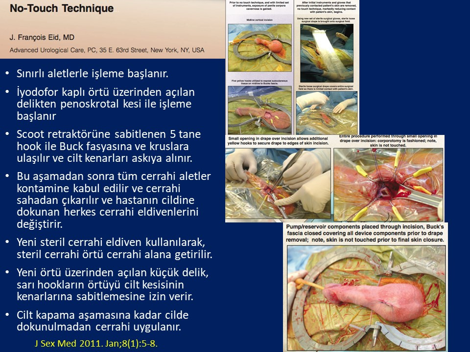 Penil Protez İmplantasyonu