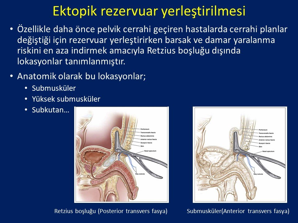 Penil Protez İmplantasyonu