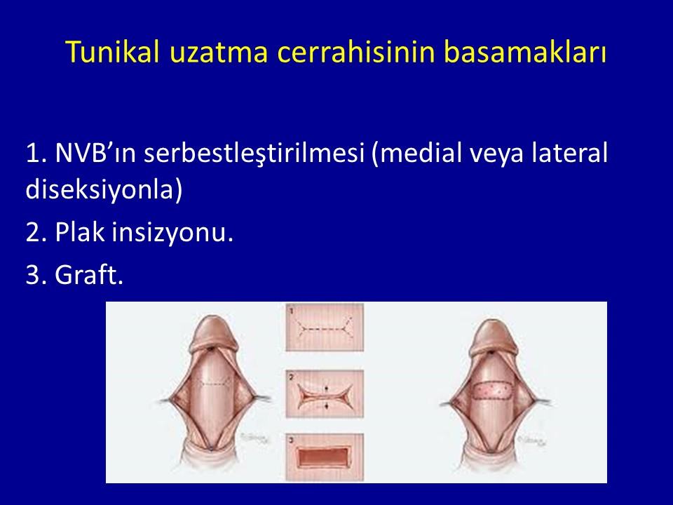 Peyronie Rekonstrüksiyon ve Penil Protez Teknikleri